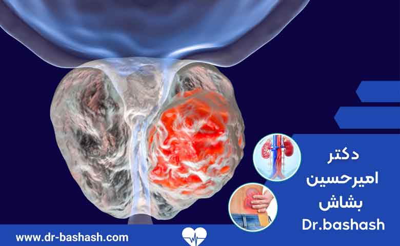 روش جراحی بسته پروستات ( turp )