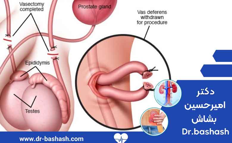 عمل وازکتومی به چه صورت انجام می شود؟