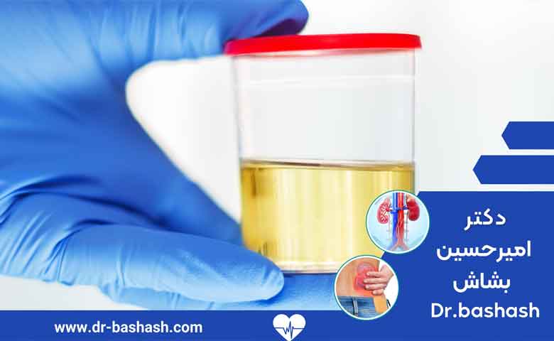 علت و علائم سوزش ادرار چیست؟