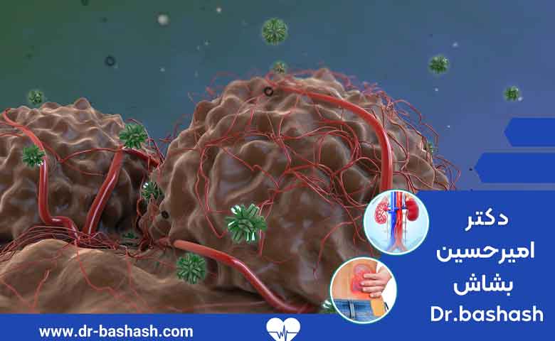 علائم و نشانه‌های تومور و سرطان مثانه