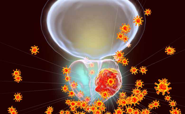 راههای پیشگیری از سرطان مثانه