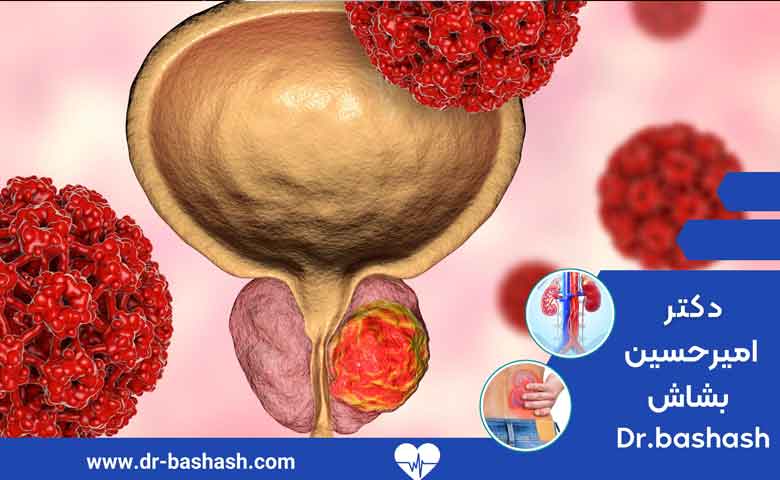 راههای پیشگیری از سرطان مثانه یا تومور مثانه