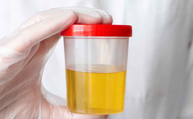 علائم سوزش ادرار چیست ؟