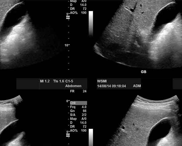 درمان مثانه عصبی