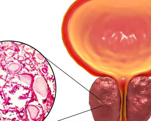 درمان بزرگی و بدخیمی پروستات