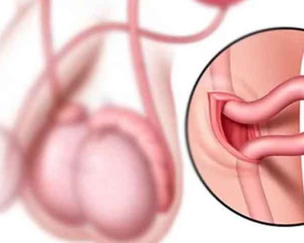 عمل باز کردن لوله مردان یا وازووازوستومی