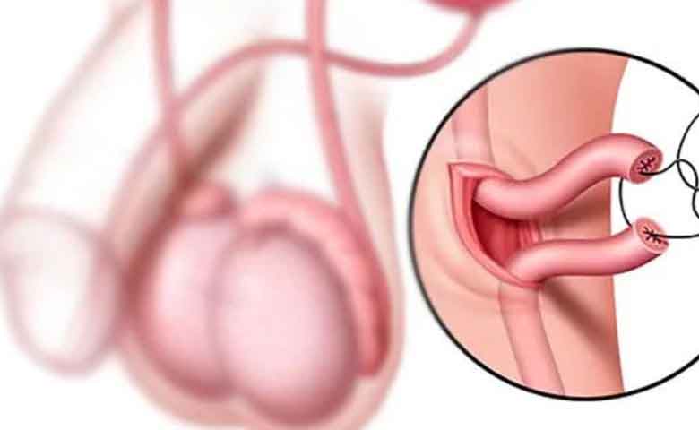 عمل باز کردن لوله مردان یا وازووازوستومی