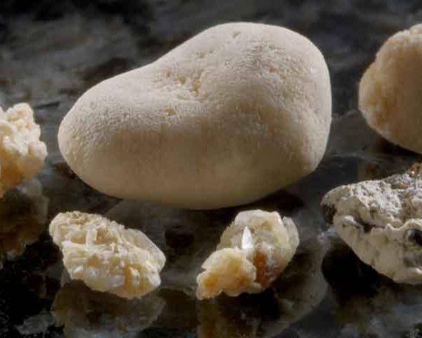 جراحی سنگ کلیه