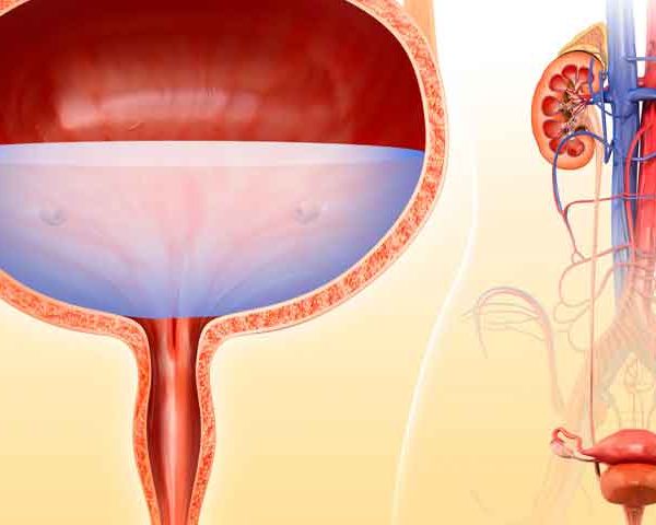 جراحی بسته سنگ مثانه