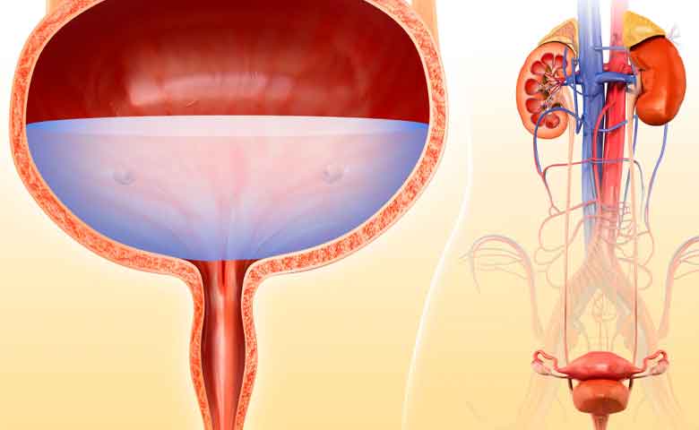 جراحی بسته سنگ مثانه