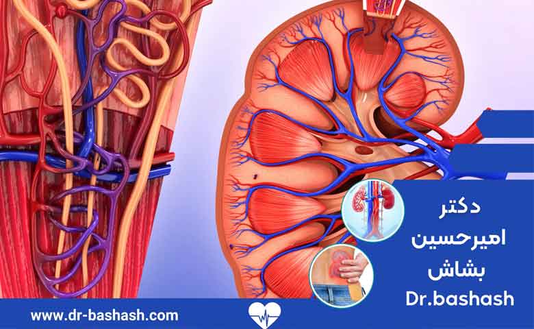عمل سنگ کلیه در حالب