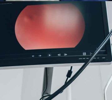 انجام آندوسکوپی و سیستوسکوپی مثانه