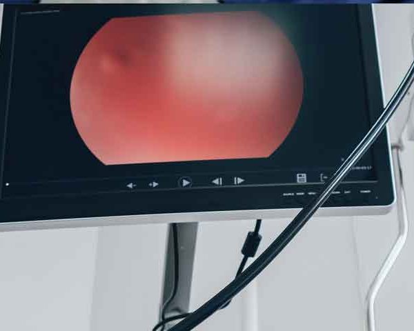 انجام آندوسکوپی و سیستوسکوپی مثانه