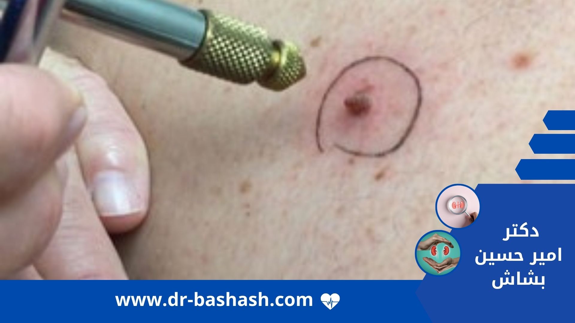 درمان زگیل تناسلی در مشهد