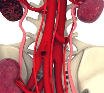 درمان کیست کلیه