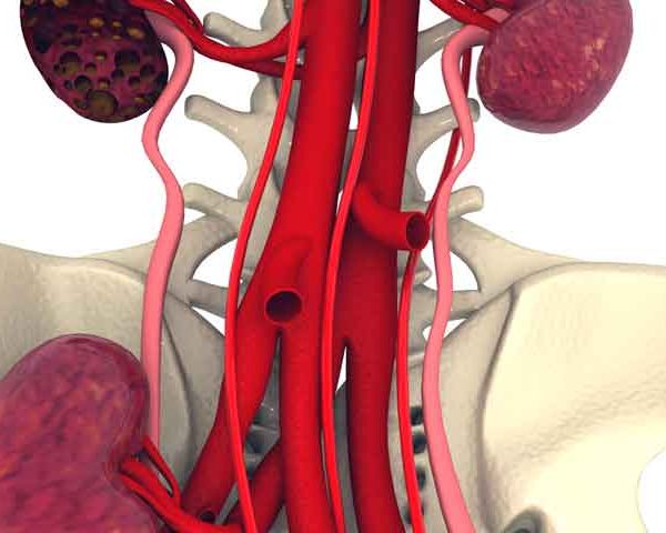 درمان کیست کلیه