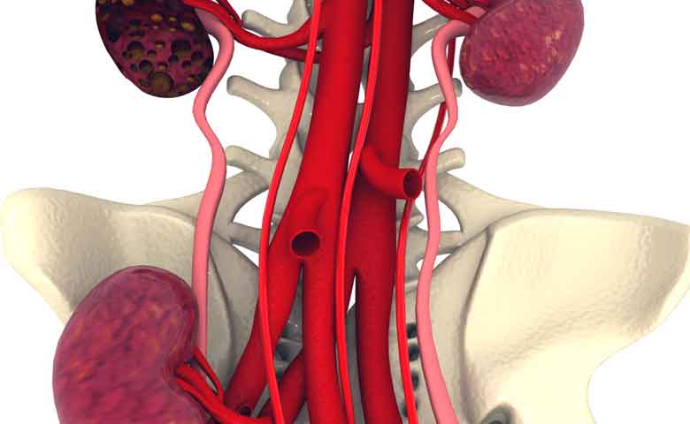 درمان کیست کلیه