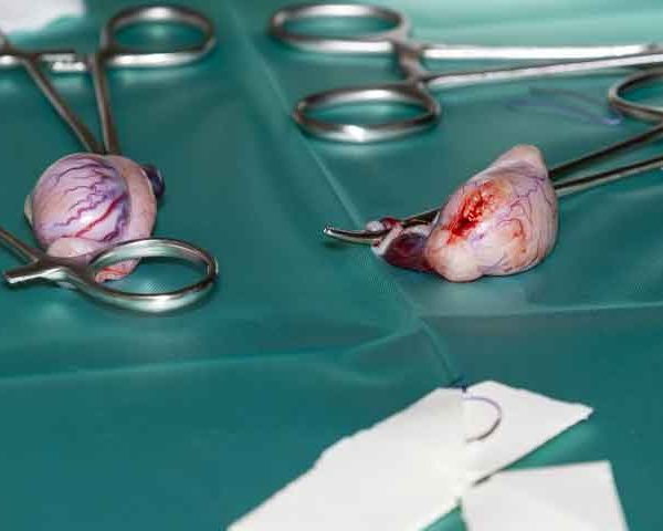 همه چیز درباره عمل وازکتومی قسمت اول