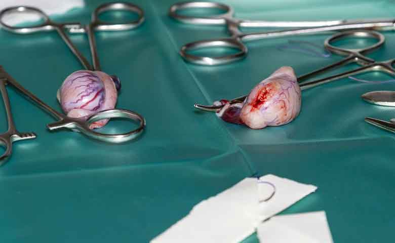 همه چیز درباره عمل وازکتومی قسمت اول