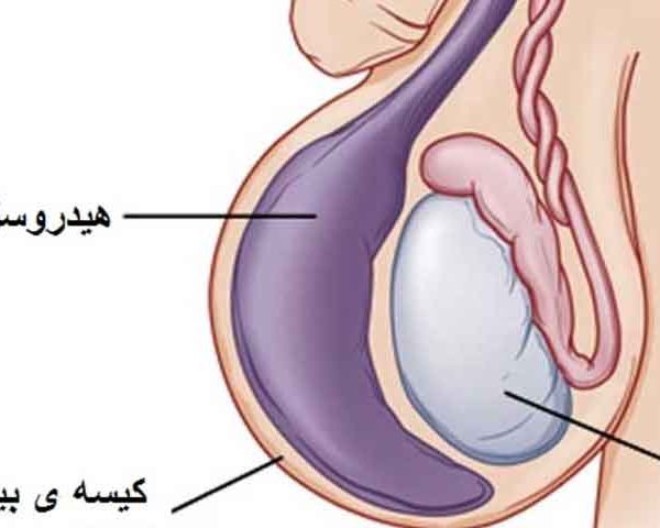 هیدروسل، عوارض، علل ایجاد و درمان آن چیست؟