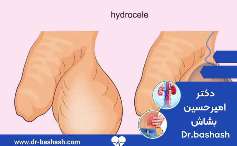 انواع جراحی هیدروسل چیست ؟