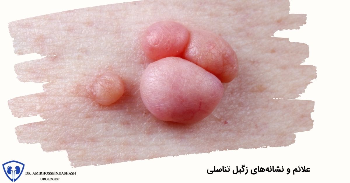 علائم و نشانه‌های زگیل تناسلی