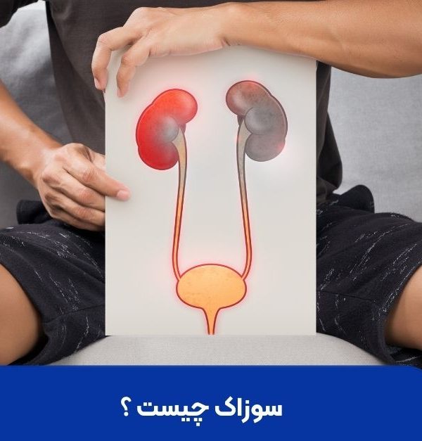 سوزاک چیست ؟