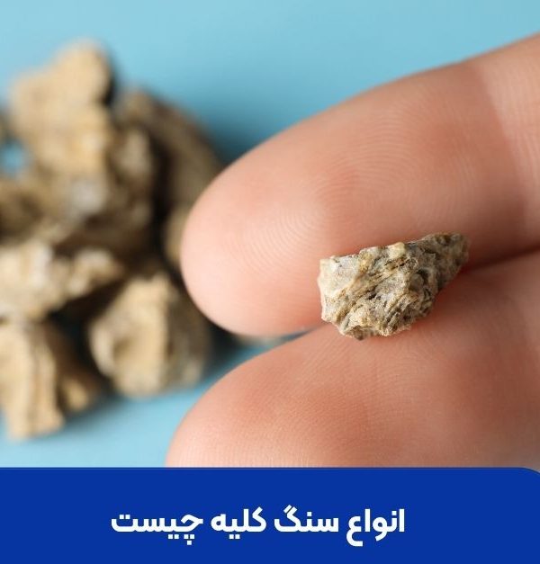 انواع سنگ کلیه چیست