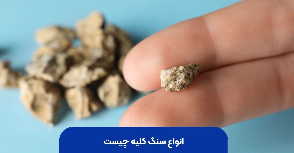 انواع سنگ کلیه چیست