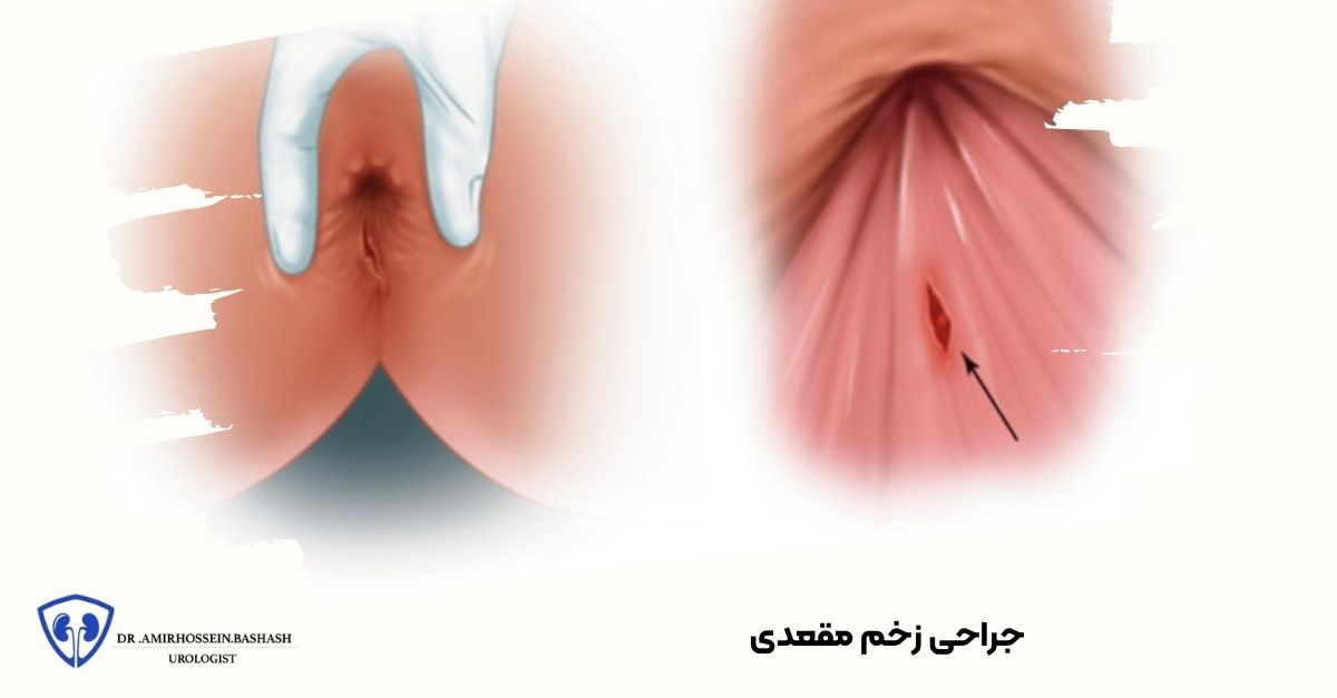 جراحی زخم مقعدی