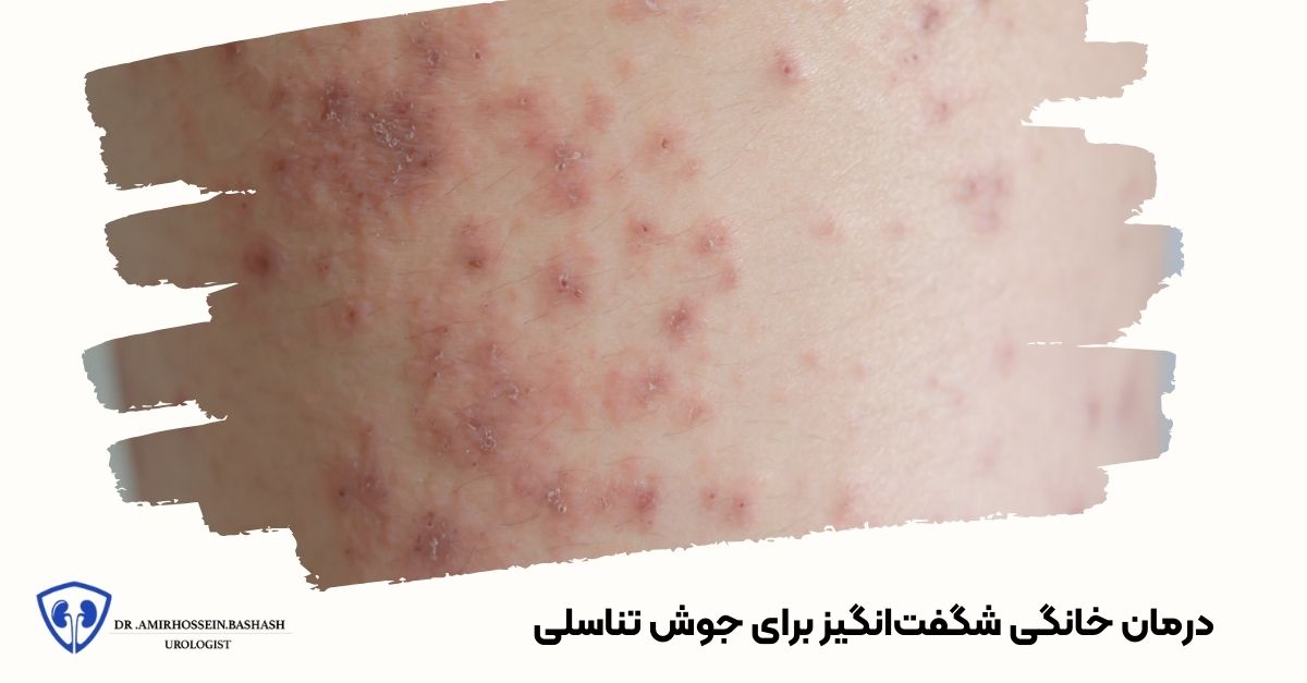 درمان خانگی شگفت‌انگیز برای جوش تناسلی