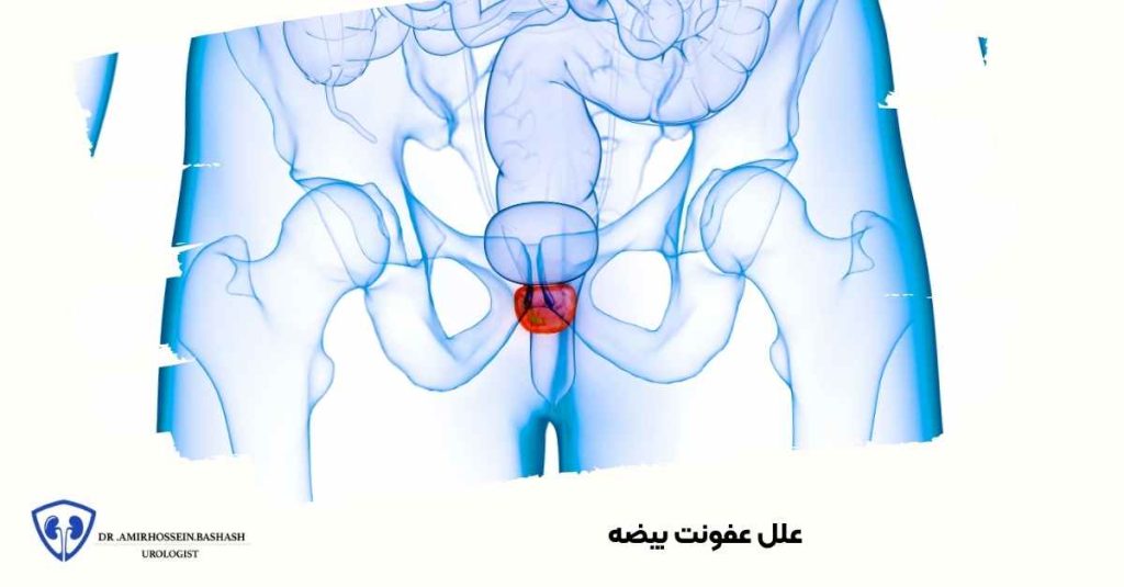 علل عفونت بیضه