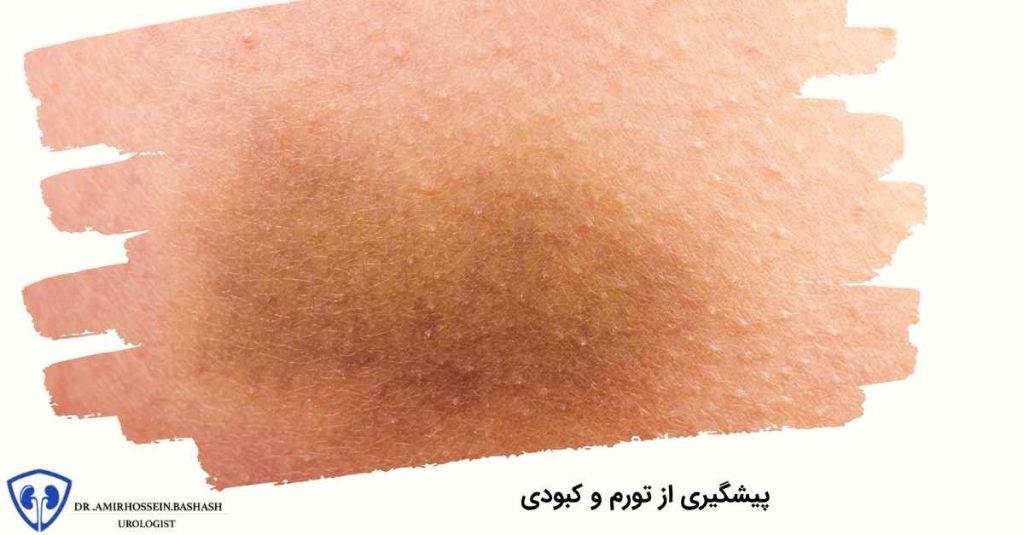 پیشگیری از تورم و کبودی