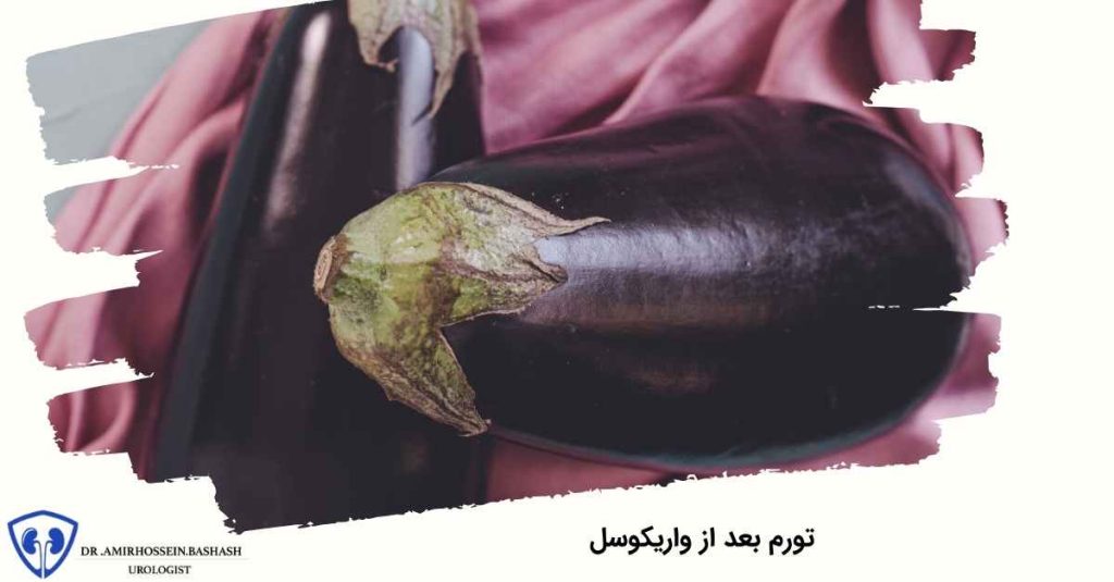 تورم بعد از واریکوسل