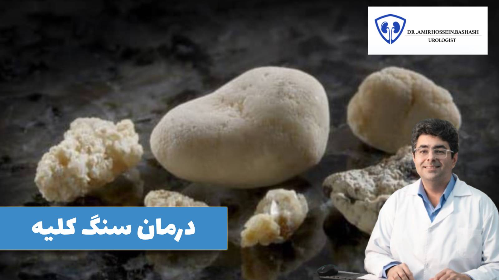 سنگ کلیه