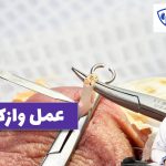 عمل وازکتومی