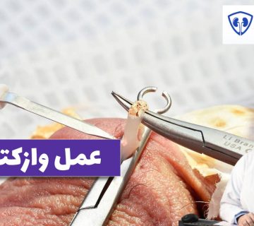 عمل وازکتومی