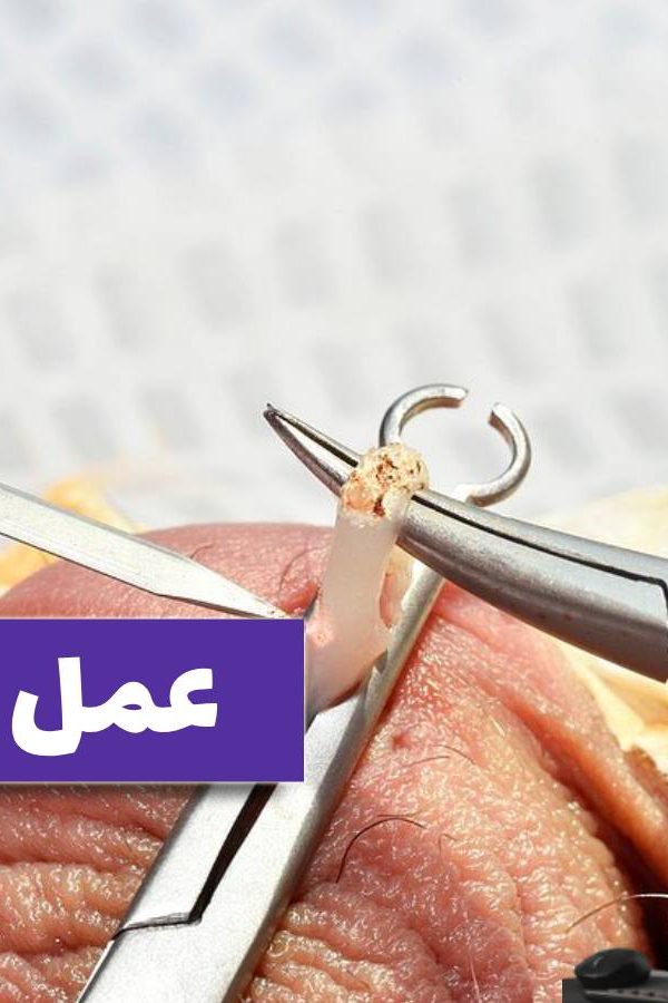 عمل وازکتومی