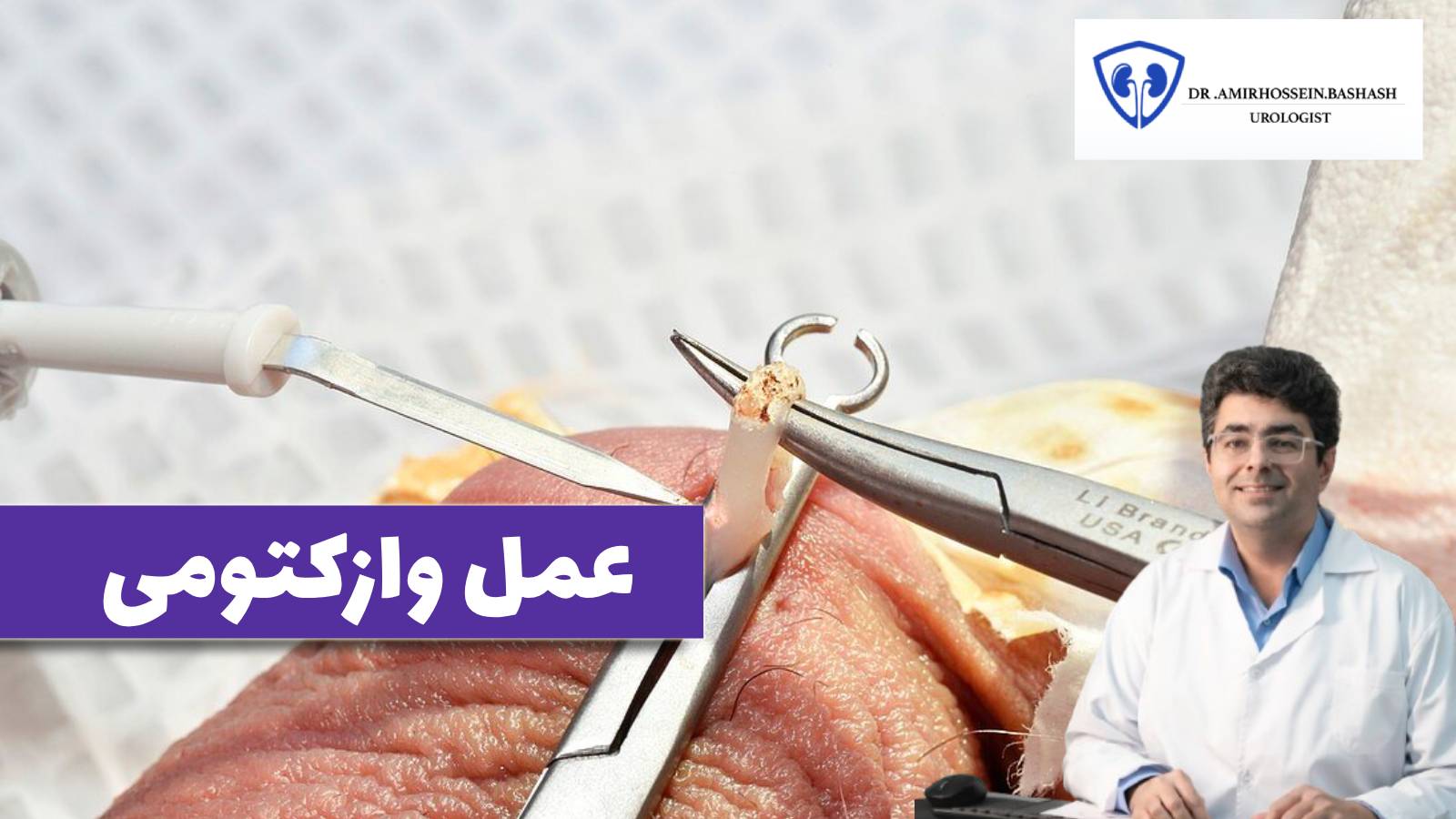 عمل وازکتومی